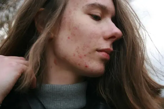 Jeune femme avec de l'acnée à cause d'une surconsommation de sucre