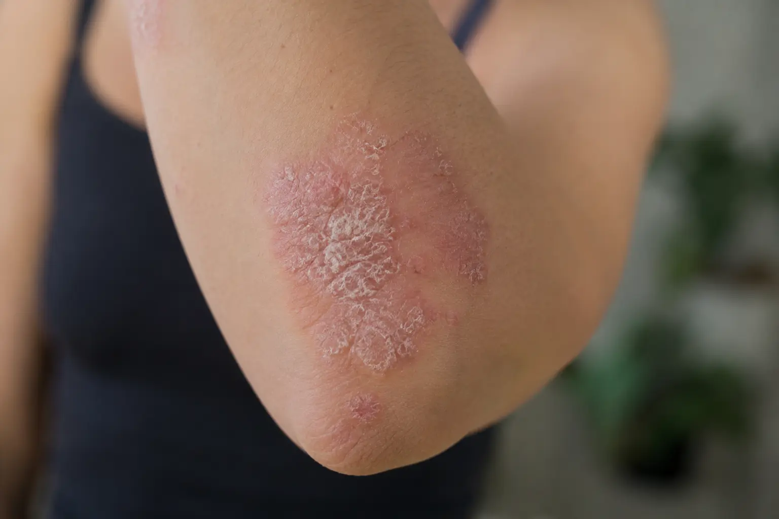 Plaque de psoriasis, rouge et squameuse